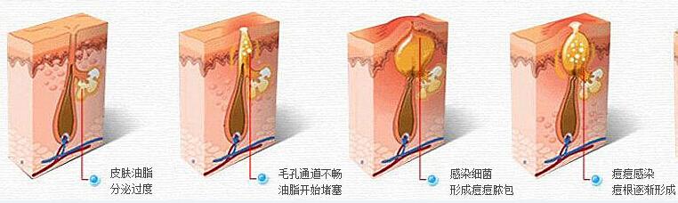 武汉青春痘怎么治疗