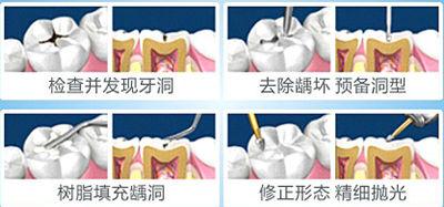 武汉怎么补牙