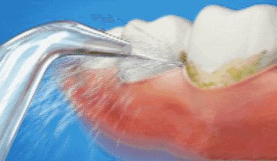 武汉洗牙洗掉的是什么