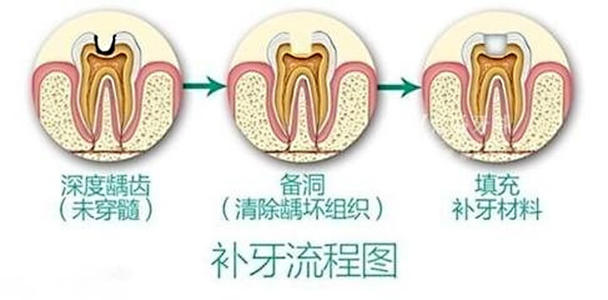 武汉补牙多少钱