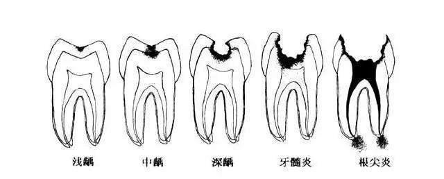 武汉补牙为什么要趁早