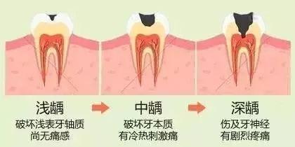 武汉补牙为什么要趁早