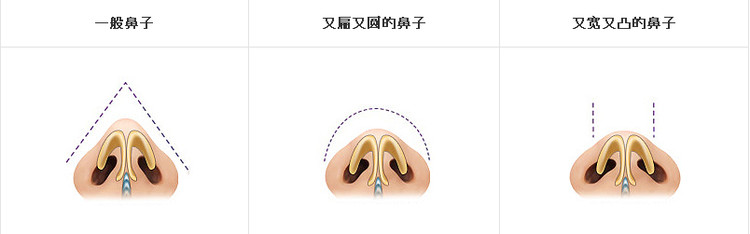 武汉鼻翼缩小怎么做