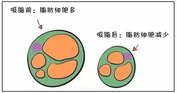 武汉大腿吸脂能瘦腿吗