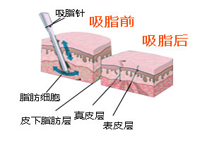 武汉为什么很多人选冬天吸脂