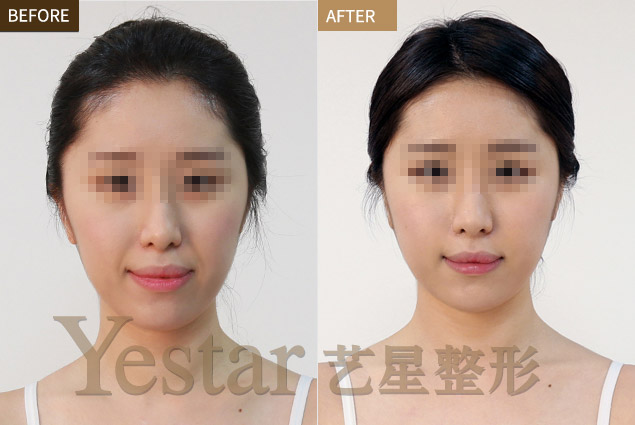 瘦身成功卻憔悴了容顏 Yestar武汉艺星医疗美容来帮忙