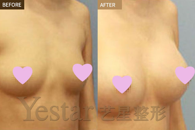 未怀孕女性能隆胸吗